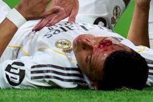 遭肘击流血！皇马官方：姆巴佩眉骨缝针，，，，，，缺席球队今日合练_24直播网